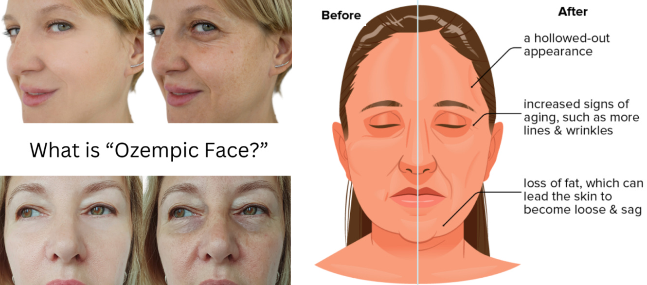 Preview Factors Boosting Ozempic Effectiveness Identified