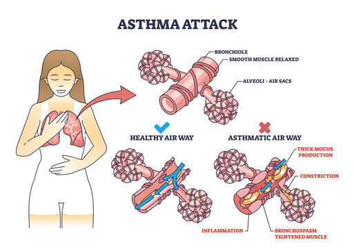 Preview Unexpected Way Found to Ease Asthma Attacks