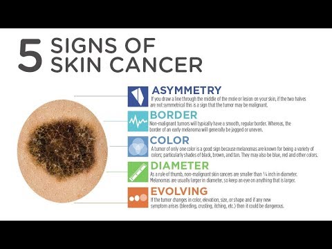 Preview Man Has Half His Body Removed Due to Skin Cancer