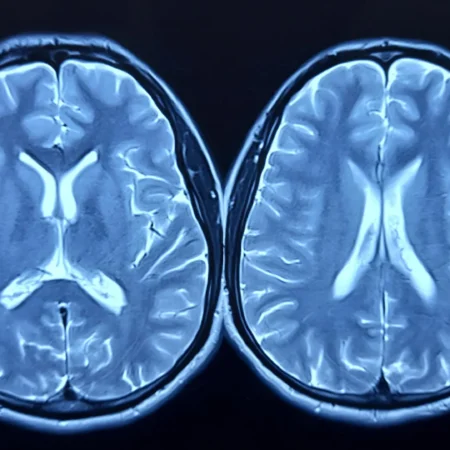 Unexpected Impact of the Pandemic: Brain Aging Accelerated Even in Healthy Individuals