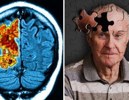 Scientists Discover Way to Reverse Brain Damage in Alzheimer’s Disease