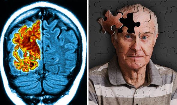 Preview Scientists Discover Way to Reverse Brain Damage in Alzheimer’s Disease