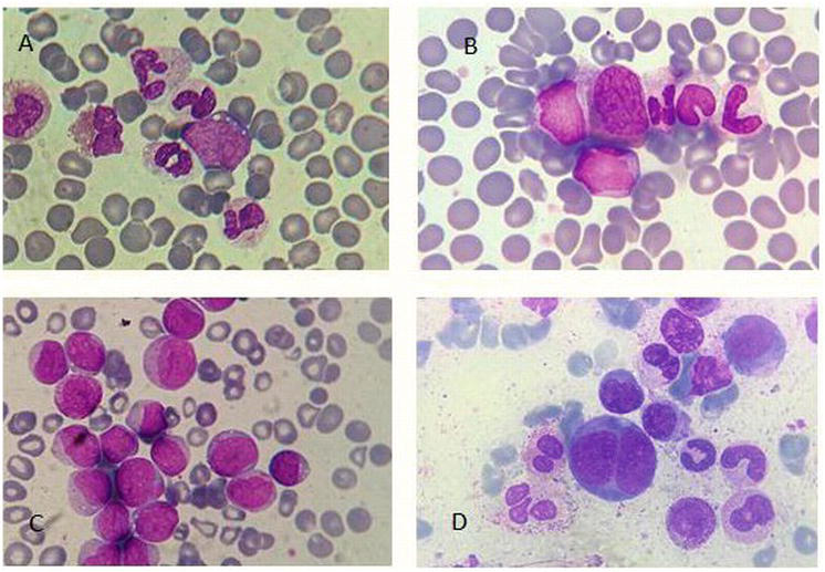 Preview Effective New Method Discovered to Combat Leukemia