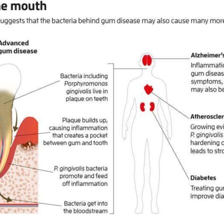 Unexpected Heart Attack Cause: Hidden Oral Bacteria Uncovered