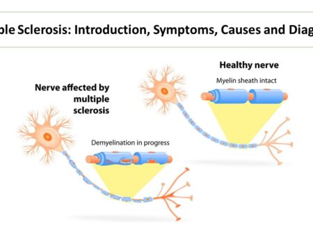 Novel Approach to Nerve Regeneration in Multiple Sclerosis