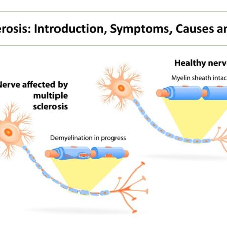 Novel Approach to Nerve Regeneration in Multiple Sclerosis