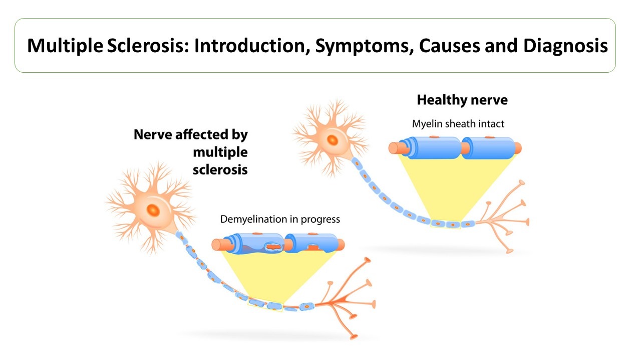 Preview Novel Approach to Nerve Regeneration in Multiple Sclerosis