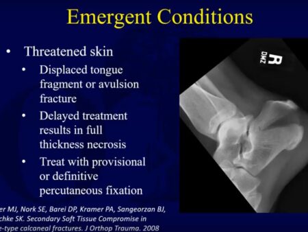 Revolutionary Device for On-Site Fracture Treatment
