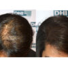 Effective Hair Loss Treatment Discovered