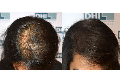 Effective Hair Loss Treatment Discovered