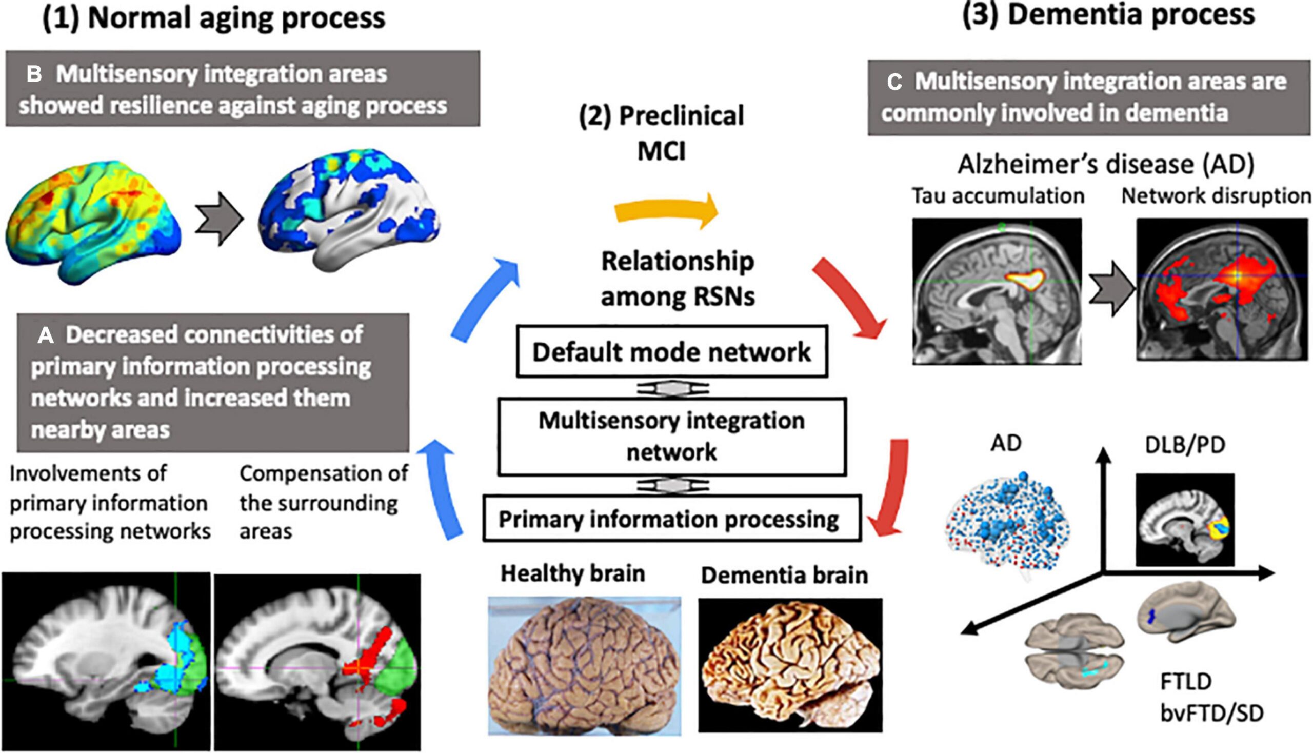 Preview Accelerated Brain Aging Marker Identified, Linked to Anxiety